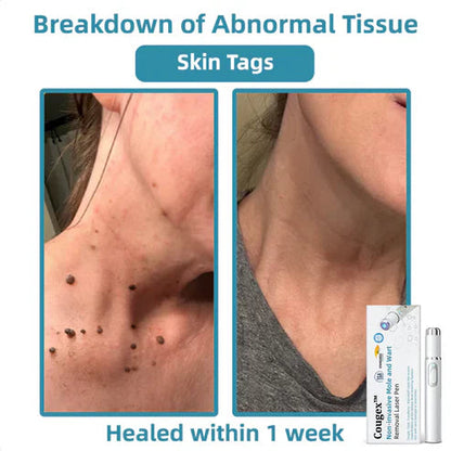 xorita mole and wart remover