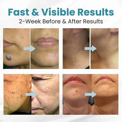 xorita mole and wart remover